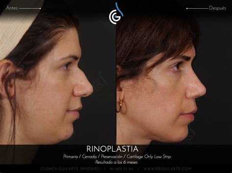 Caso Foto Rinoplastia Drguilarte