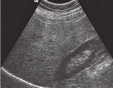 Liver Steatosis Ultrasound