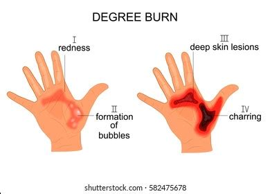 First Degree Burn Cartoon Photos Images Pictures Shutterstock