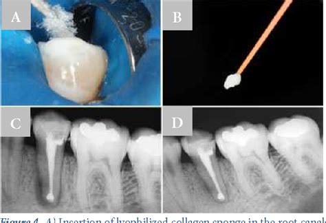 Figure 4 From Endodontic Management Of Open Apex Teeth Using