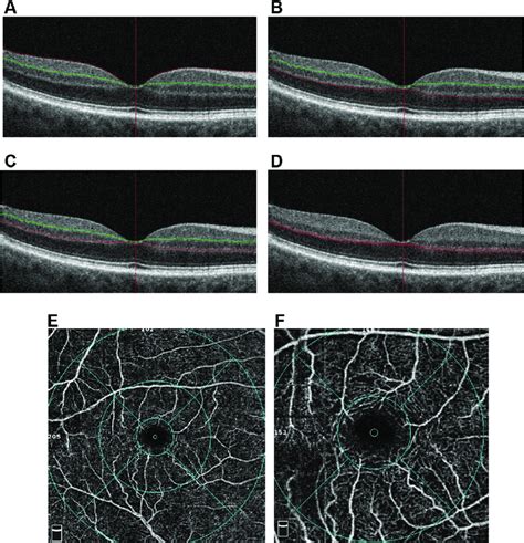 Optical Coherence Tomography Oct And Oct Angiography Octa Images Of