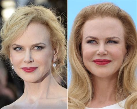 Nicole Kidman before and after plastic surgery (21) | Celebrity plastic