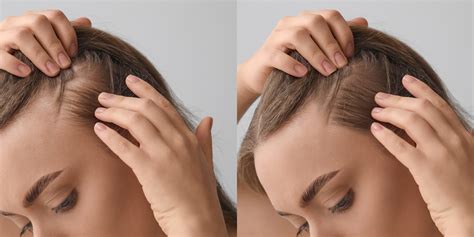 Hair Loss In Women Causes Treatment And Prevention