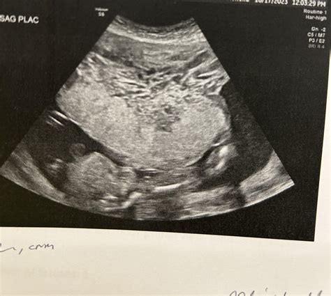 Placenta Accreta Perceta Increta Rpregnantnurses