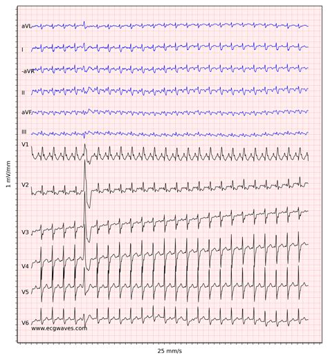 Atrial Flutter Classification Causes Ecg Criteria And Management