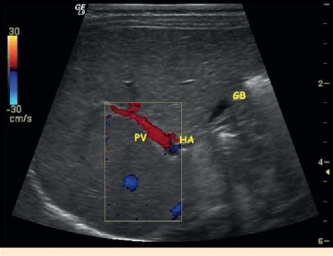 Ultrasound Scanning In Infants With Biliary Atresia The Different