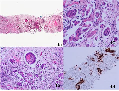 A D Low Grade Serous Morphology On Initial Biopsy 1a H E Scanning