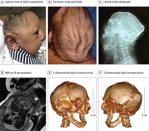 Characterizing The Pattern Of Anomalies In Congenital Zika Syndrome For