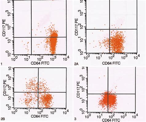 A Acute Monocytic Leukemia Reveals Moderate 2 Cd64 Expression Lower Download Scientific