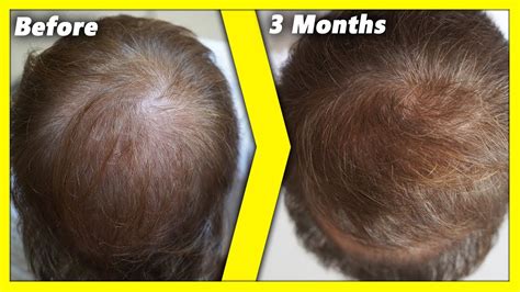 Topical Finasteride 3 Months Before And After Result Youtube