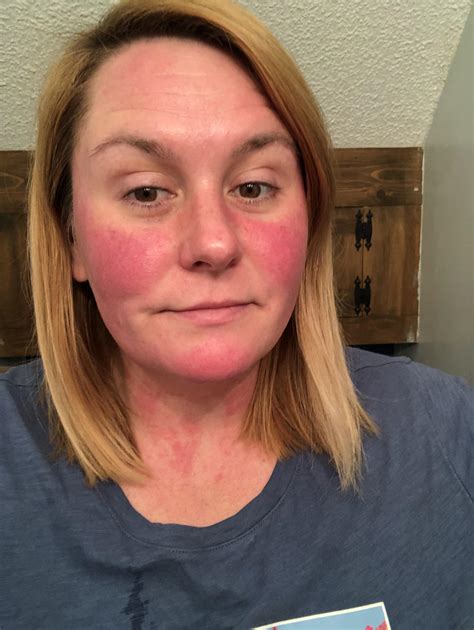 1202 best r/rosacea images on Pholder | Went out last night without any