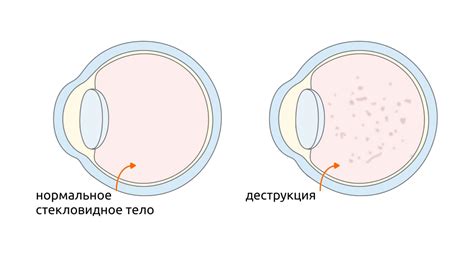 Стекловидное Тело Картинки – Telegraph