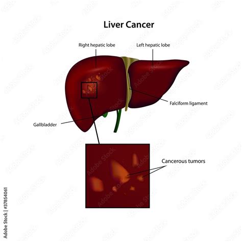 Liver Cancer Vector Illustration Stock Vector Adobe Stock