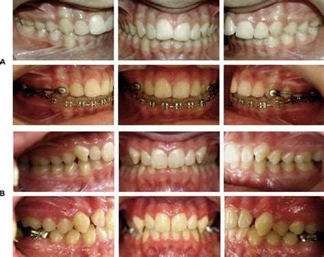 Treatment effects of the Carrière distalizer using lingual arch and