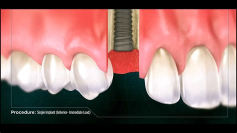 Dental Implant YouTube