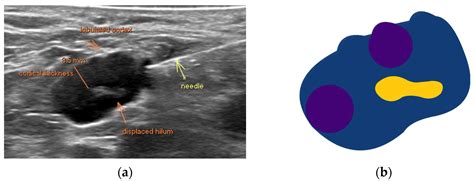 Jmp Free Full Text The Value Of Fine Needle Aspiration Biopsy In