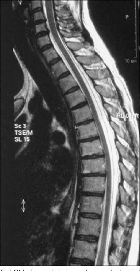 Figure 3 From Síndrome De Hipotensión Intracraneal Espontánea Tratada