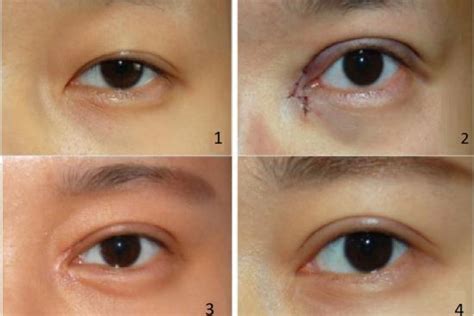 Canthoplasty In Turkey Techniques Results And Costs