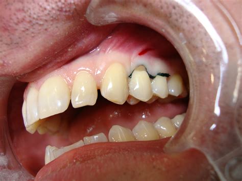 Сколько стоит поставить пломбу на зуб. Пломбирование зубов в клинике ...