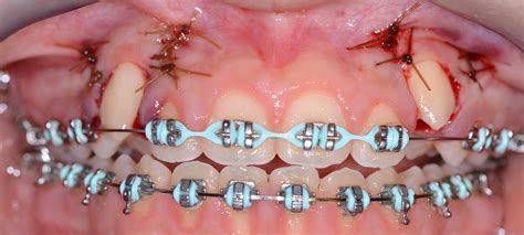 Facilitating Orthodontic Therapy Tyler Periodontics