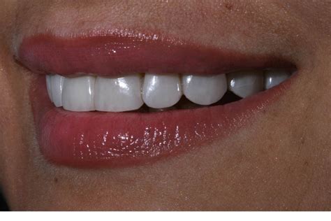 Platinum Veneers Or Dental Veneers Uncut