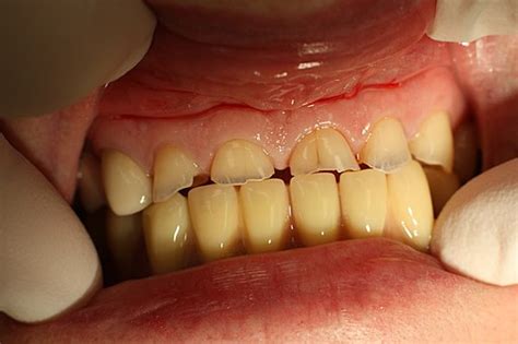 Dental Erosion From Abrasion Abfraction Postgraduate Dentistry