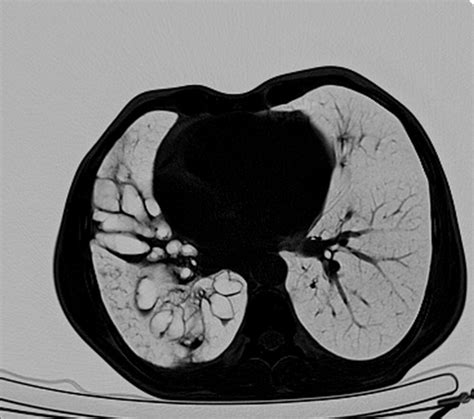 Nithesh Ravindran On Linkedin A Case Of Cystic Broncheictasis With Bw