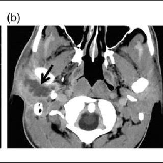 Acute Sialadenitis A Axial Contrast Computed Tomography Ct Scan