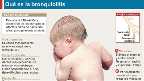 Bronquiolitis Es La época Del Contagio • Diario Democracia