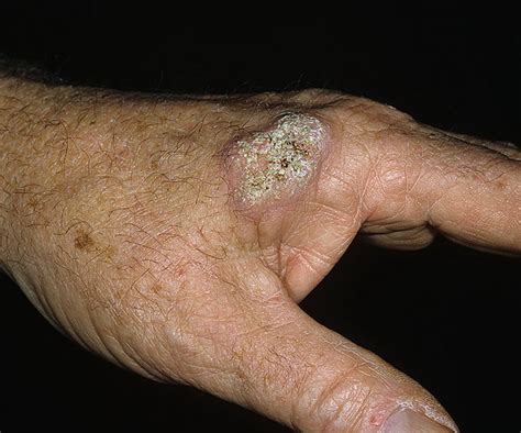 skin cancer  hands pictures   images illnesseecom