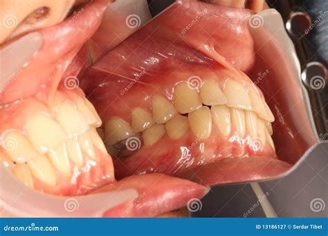Buccal view stock image. Image of gingiva, crone, bone - 13186127 