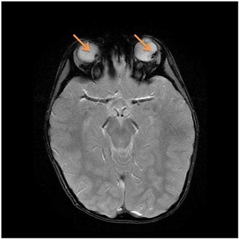 Trilateral Retinoblastoma A Rare Tumor Involving The “third Eye” Eurorad