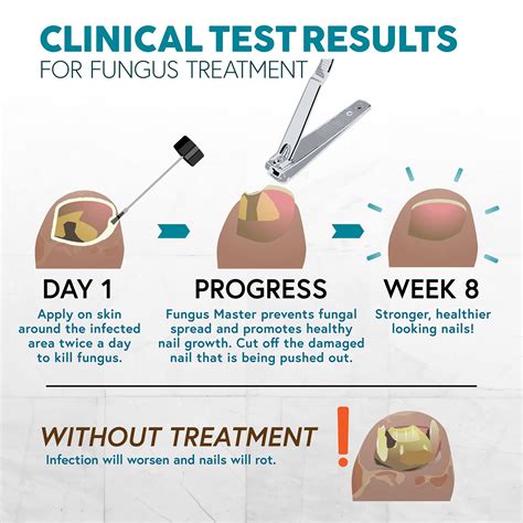 Buy Ebanel Foot Fungus Treatment Extra Strength Athletes Foot Cream