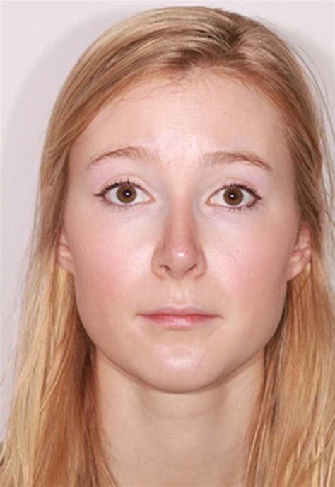Results Harley Street Nose Clinic