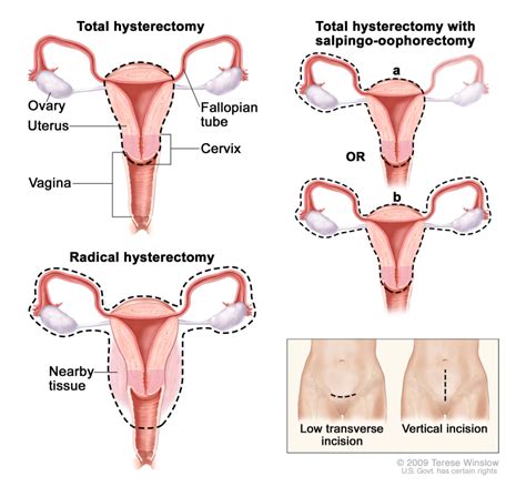 [figure Hysterectomy The Uterus Is Surgically ] Pdq Cancer Information Summaries Ncbi