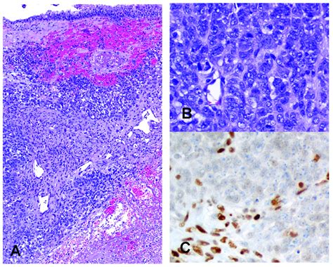 SMARCA4 Deficient Sinonasal Carcinoma Nests Of Undifferentiated Tumor