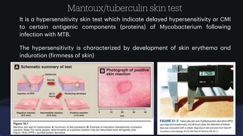 Lecture on Mycobacterium_Tuberculosis (SBMC).pdf 
