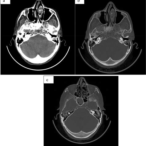 Paranasal computed tomography (CT) scan: (a), (b) axial section: concha ...