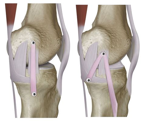 Lesão do Ligamento Colateral Medial do Joelho Especialista em Joelho