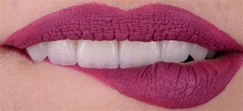 Вініри – Стоматологія «VIAS» – стоматологія майбутнього в Тернополі.