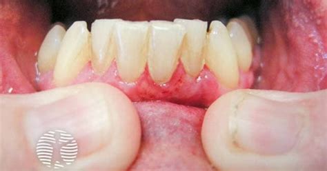 Linear IgA Bullous Disease Image