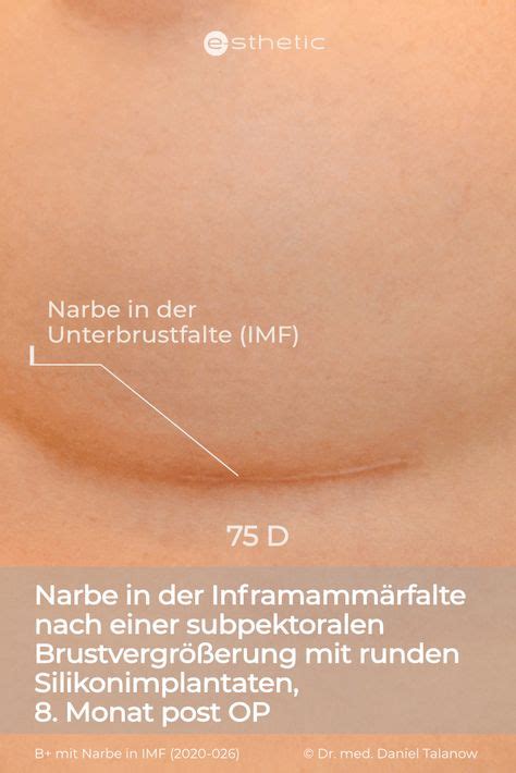 13 Narben nach Brustvergrösserung e sthetic Klinik Ideen