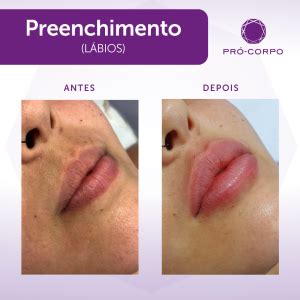 Tudo que você precisa saber sobre Preenchimento Labial