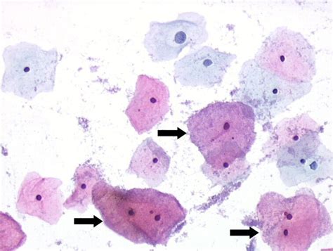 Clue Cells On Pap Smear Kieranroscole
