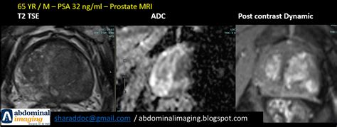 Biparametric Prostate MRI without ADC