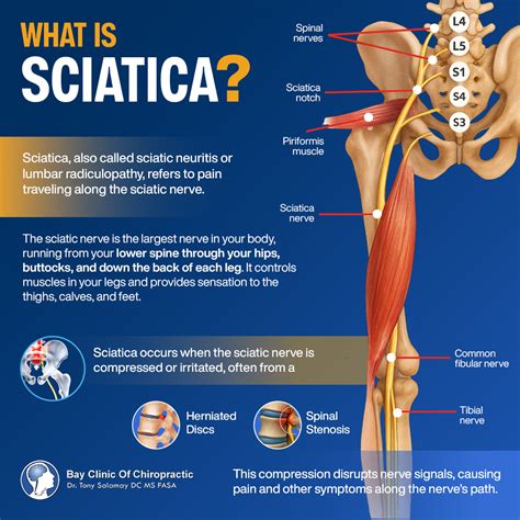 sciatica symptoms     relieve sciatic pain naturally