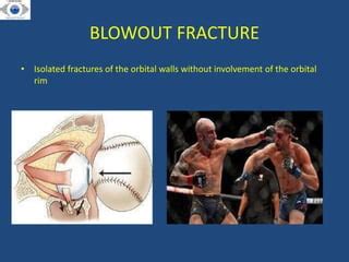 BLOW_OUT_FRACTURE_(1) presentation dhir hospital bhiwani.pptx