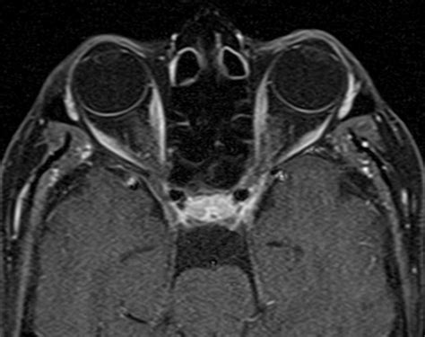 Planum Sphenoidale Meningioma Image Radiopaedia Org