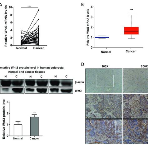 Expression Of Wnt3 Is Upregulated In Human Colorectal Cancer CRC