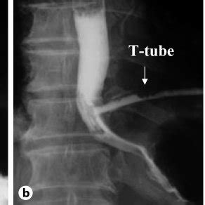 Pdf Successful Late Management Of Esophageal Perforation With T Tube